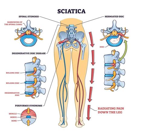 Sciatica